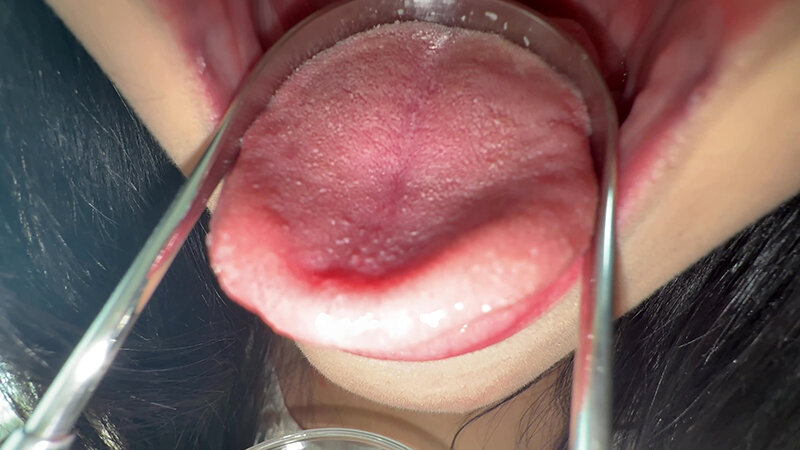 【個人撮影】桃瀬まゆの舌ブラシで「汚舌苔」採取 サンプル 10